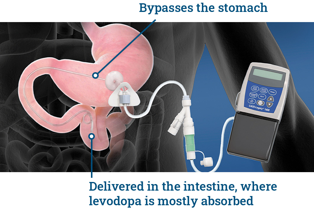 How Duopa Works Duopa™ Carbidopalevodopa